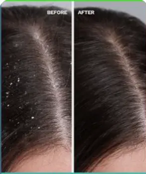 Anti-Dandruff Treatment | Scalp Fungal Control Patna — hair at Kritika Ladies Beauty Parlour, Patna